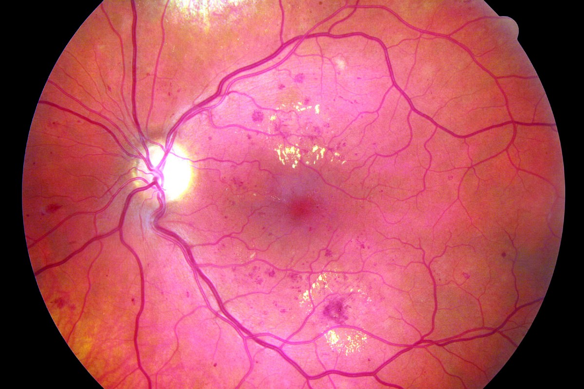 Vyšetření sítnice při diabetické retinopathii