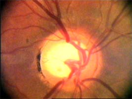 cévy a poškození terče glaukomem