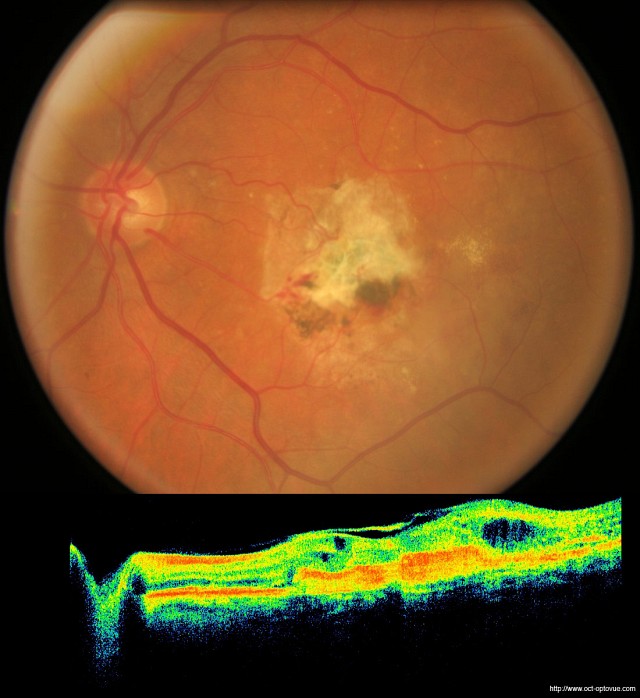 Optická koherenční tomografie „OCT“