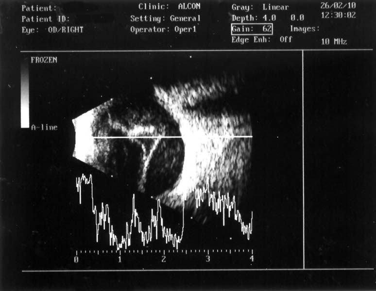Vyšetření oka ultrazvukem